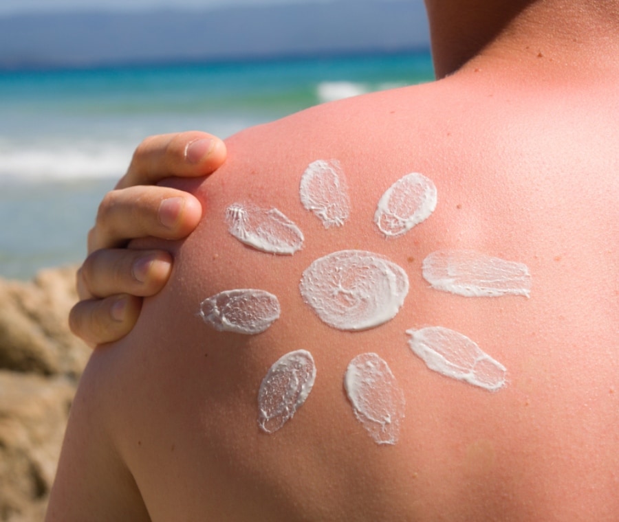 Rimediare alle scottature